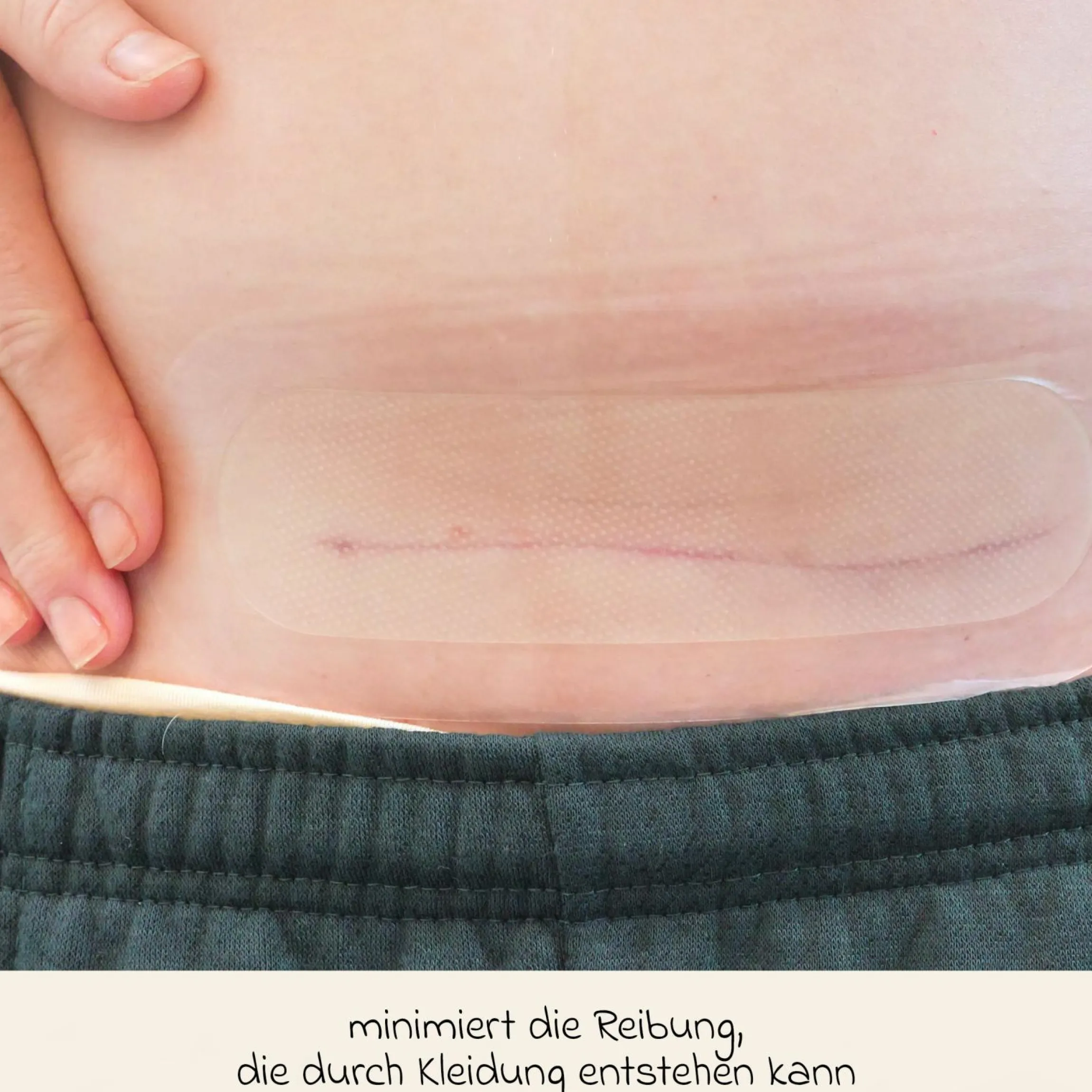 Kaiserschnitt-Hydrogel-Pads 2er Pack